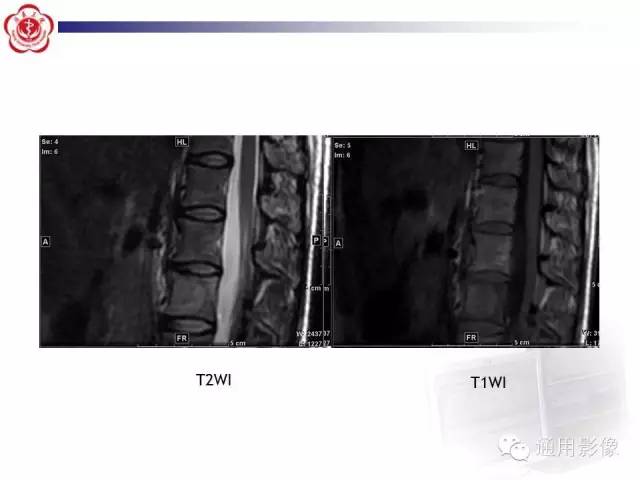 【病例】骶骨结核1例影像表现