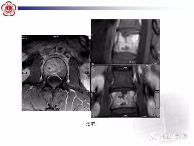 【病例】骶骨结核1例影像表现