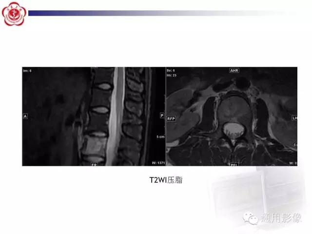 【病例】骶骨结核1例影像表现