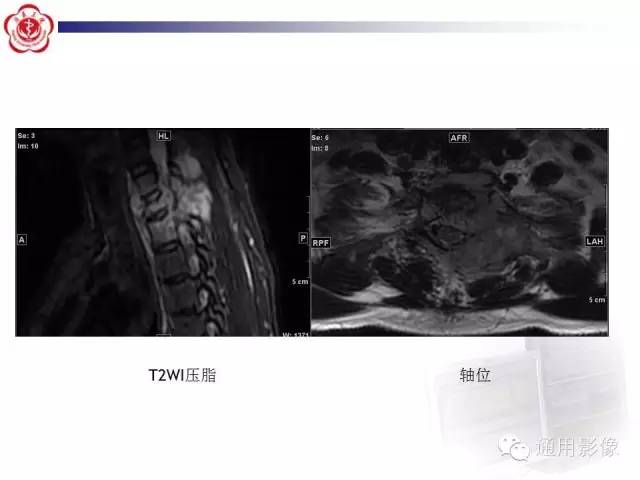 【病例】骶骨结核1例影像表现