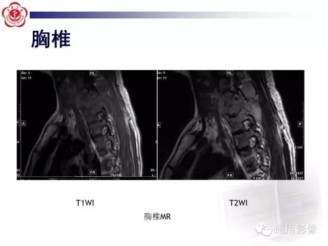 【病例】骶骨结核1例影像表现