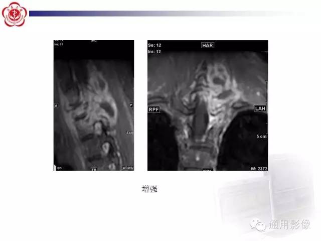 【病例】骶骨结核1例影像表现