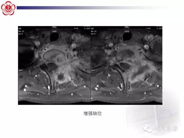 【病例】骶骨结核1例影像表现