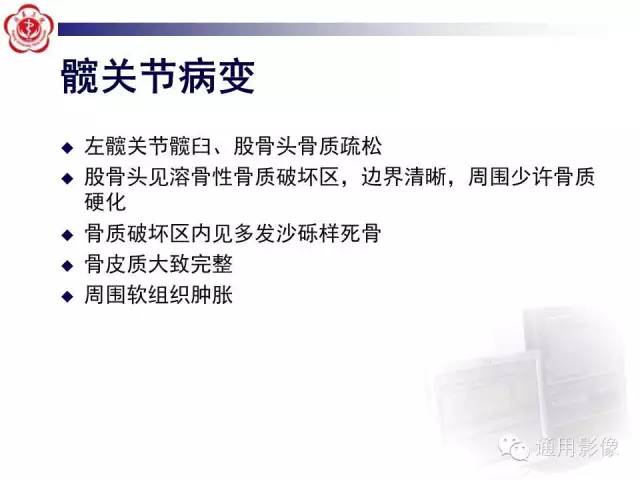 【病例】骶骨结核1例影像表现
