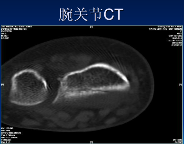 平片容易遗漏的骨折征象小结