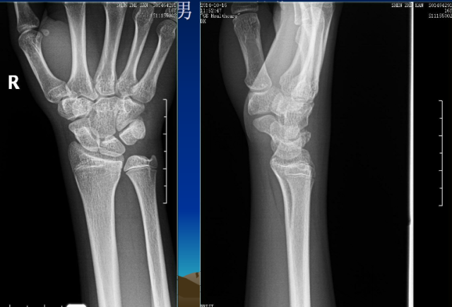 平片容易遗漏的骨折征象小结