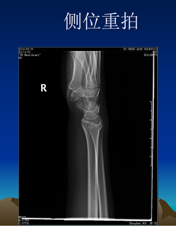 平片容易遗漏的骨折征象小结