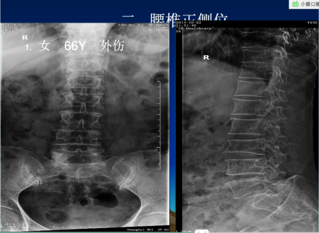 平片容易遗漏的骨折征象小结