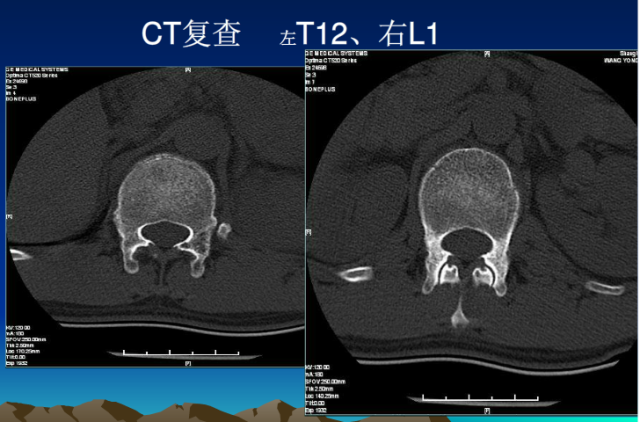 平片容易遗漏的骨折征象小结
