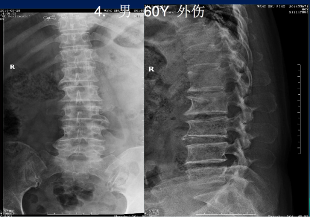 平片容易遗漏的骨折征象小结