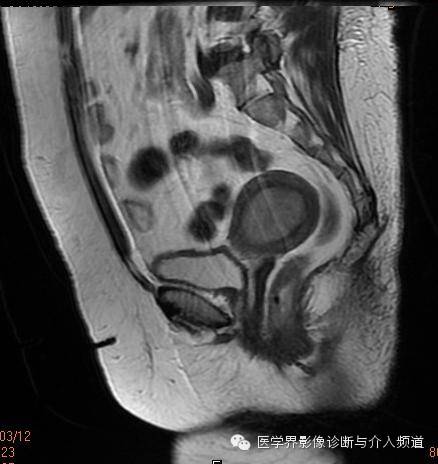 【病例】子宫内膜癌1例MR影像表现 【病例】子宫内膜癌1例MR影像表现