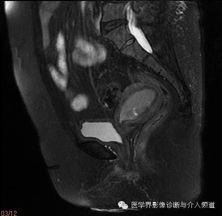 【病例】子宫内膜癌1例MR影像表现