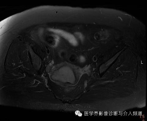 【病例】子宫内膜癌1例MR影像表现 【病例】子宫内膜癌1例MR影像表现