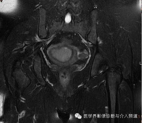 【病例】子宫内膜癌1例MR影像表现 【病例】子宫内膜癌1例MR影像表现