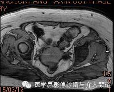 【病例】子宫内膜癌1例MR影像表现 【病例】子宫内膜癌1例MR影像表现