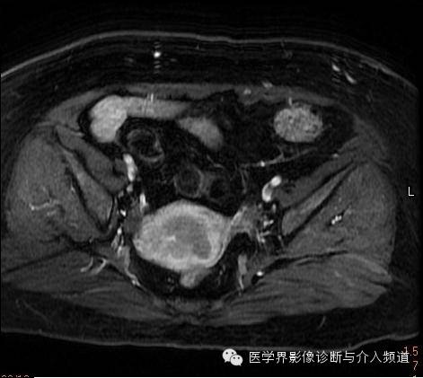 【病例】子宫内膜癌1例MR影像表现 【病例】子宫内膜癌1例MR影像表现