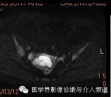 【病例】子宫内膜癌1例MR影像表现 【病例】子宫内膜癌1例MR影像表现