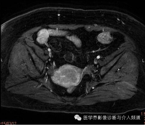 【病例】子宫内膜癌1例MR影像表现 【病例】子宫内膜癌1例MR影像表现