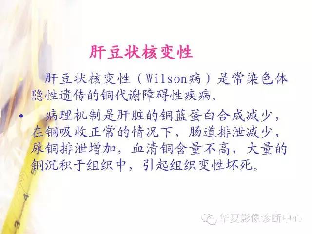 【PPT】肝豆状核变性