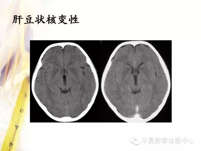 【PPT】肝豆状核变性