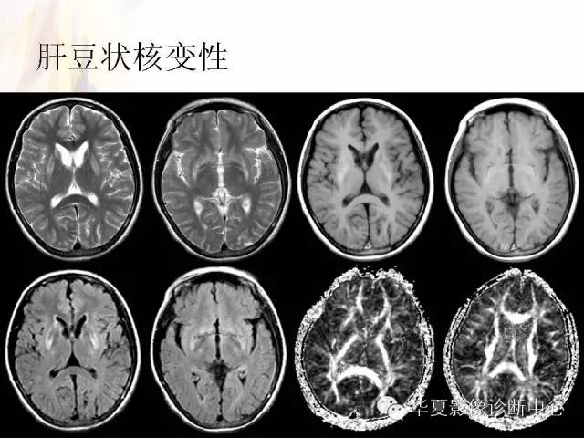【PPT】肝豆状核变性