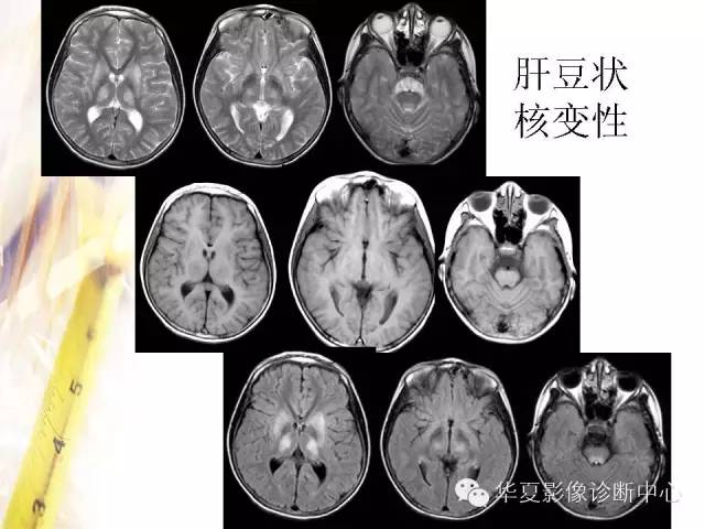 【PPT】肝豆状核变性