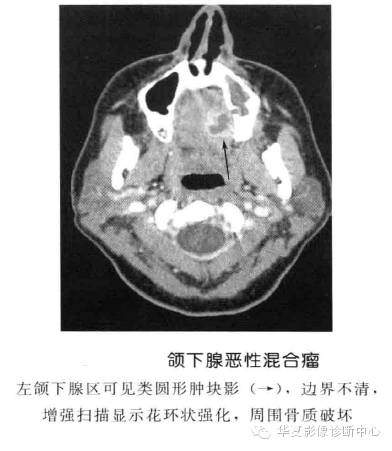 涎腺常见肿瘤的鉴别诊断