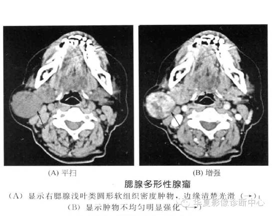 涎腺常见肿瘤的鉴别诊断