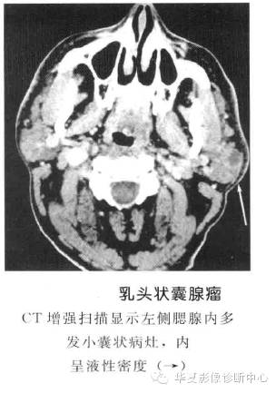 涎腺常见肿瘤的鉴别诊断