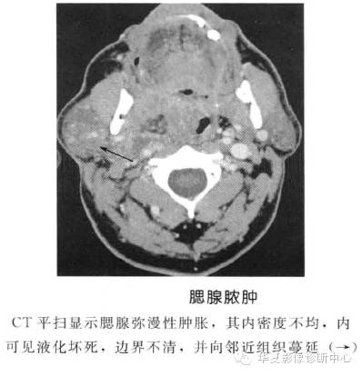 涎腺常见肿瘤的鉴别诊断