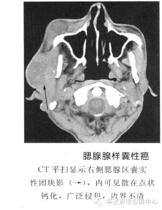 涎腺常见肿瘤的鉴别诊断