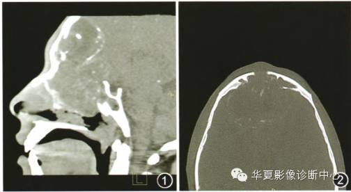 【病例】鼻腔鼻窦造釉细胞瘤侵犯颅内1例