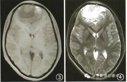 【病例】鼻腔鼻窦造釉细胞瘤侵犯颅内1例 【病例】鼻腔鼻窦造釉细胞瘤侵犯颅内1例