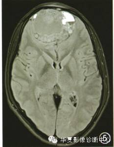 【病例】鼻腔鼻窦造釉细胞瘤侵犯颅内1例 【病例】鼻腔鼻窦造釉细胞瘤侵犯颅内1例