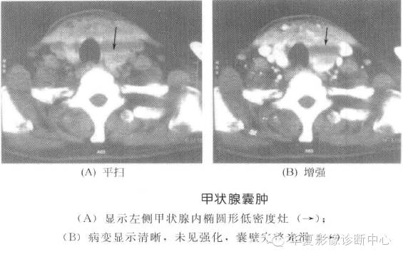 甲状腺常见肿瘤的鉴别诊断