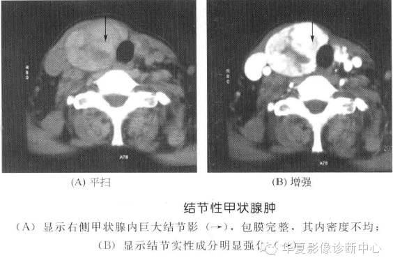 甲状腺常见肿瘤的鉴别诊断