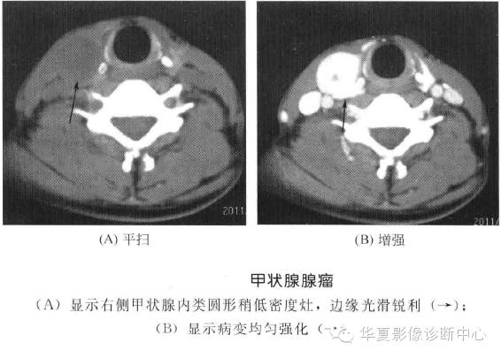 甲状腺常见肿瘤的鉴别诊断