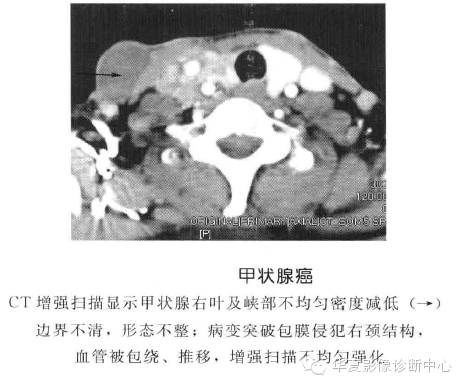 甲状腺常见肿瘤的鉴别诊断