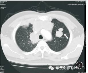 【病例】大腿黏液纤维肉瘤1例影像表现