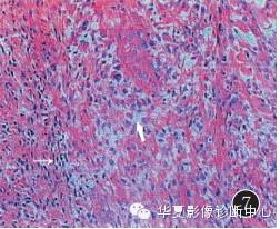 【病例】大腿黏液纤维肉瘤1例影像表现
