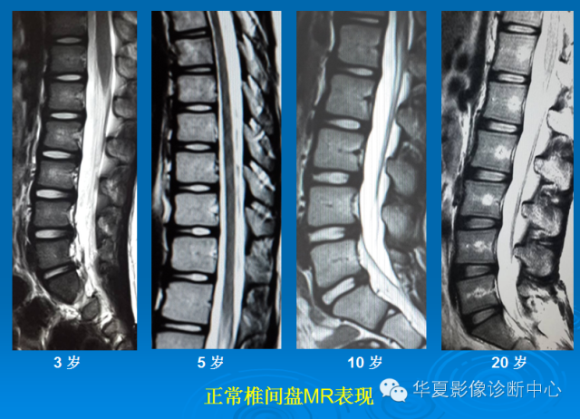 【PPT】椎间盘退变某些MR征象再认识