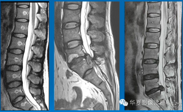 【PPT】椎间盘退变某些MR征象再认识