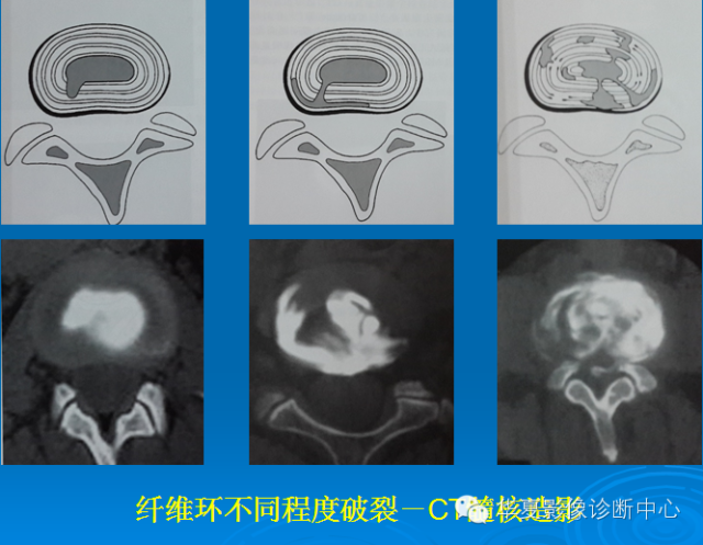 【PPT】椎间盘退变某些MR征象再认识