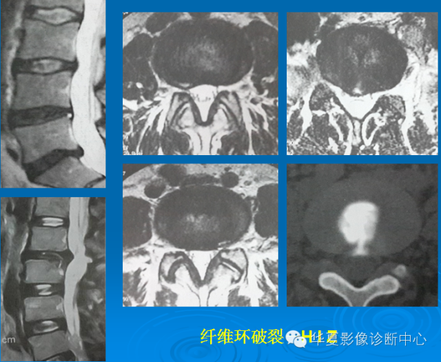 【PPT】椎间盘退变某些MR征象再认识