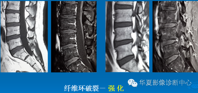 【PPT】椎间盘退变某些MR征象再认识
