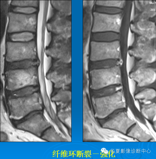 【PPT】椎间盘退变某些MR征象再认识