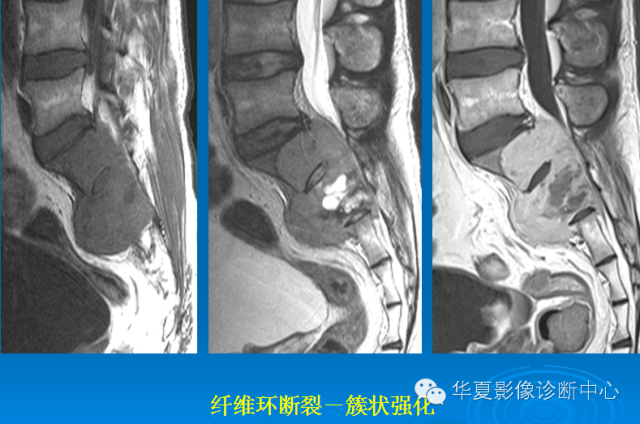 【PPT】椎间盘退变某些MR征象再认识