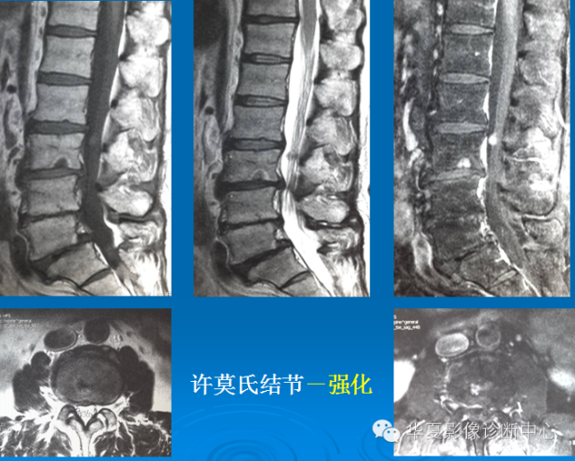 【PPT】椎间盘退变某些MR征象再认识
