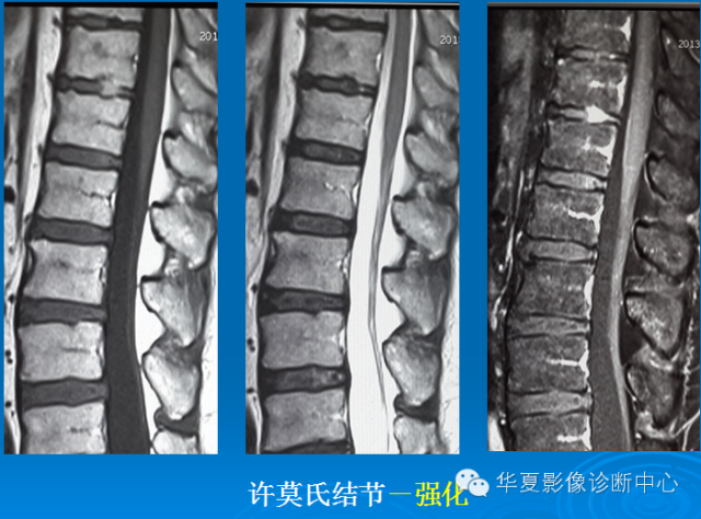 【PPT】椎间盘退变某些MR征象再认识