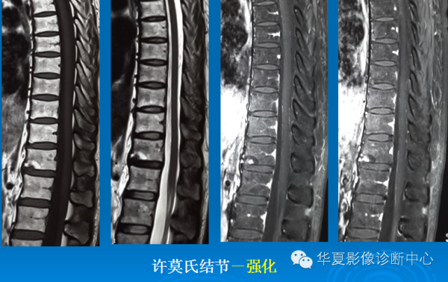 【PPT】椎间盘退变某些MR征象再认识
